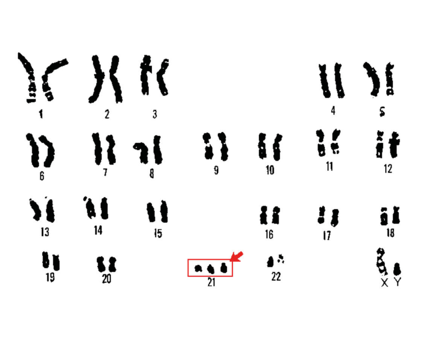 Immagine delle coppie di cromosomi nella sindrome di Down, dalla coppia 1 alla coppia 22. L'immagine evidenzia il numero 21 dove è segnato un cromosoma in più.
